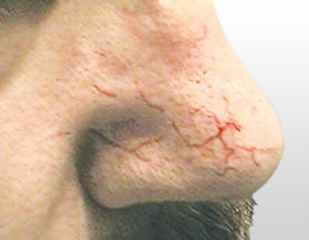 vor Behandlung Couperose