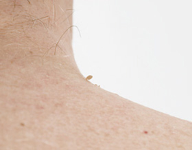 vor Behandlung Fibrom